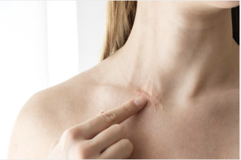 A woman gently touches a visible scar on her upper chest, highlighting the type of skin scarring often treated with silicone scar tape.