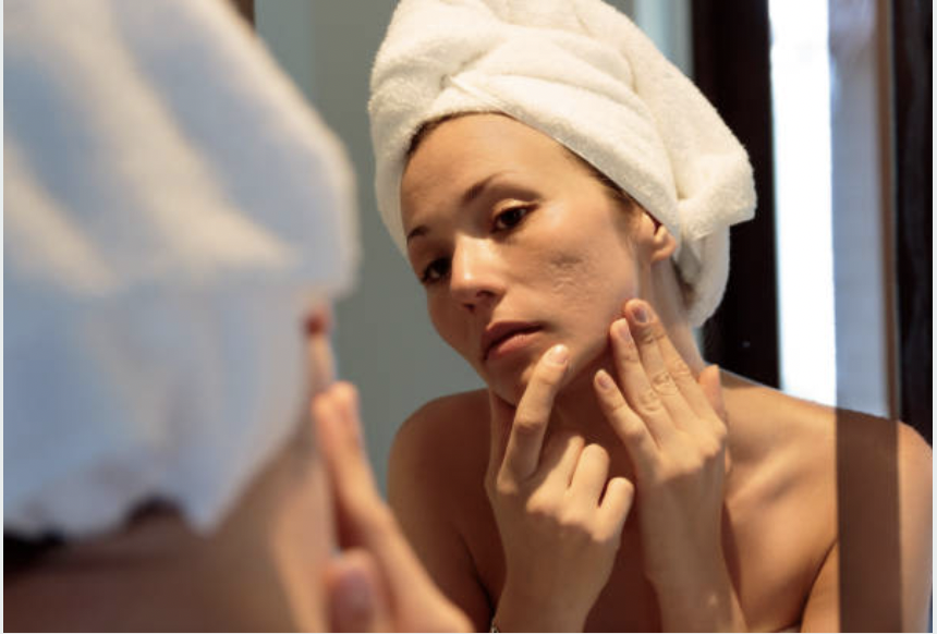 A woman with a towel wrapped around her head closely examines her acne scars in the mirror, highlighting concerns related to facial scarring.